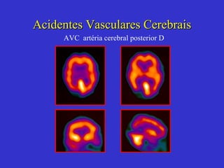 Acidentes Vasculares Cerebrais AVC  artéria cerebral posterior D 