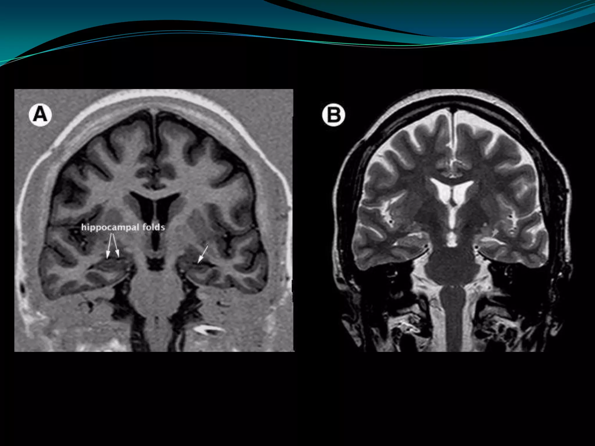 Neuro imaging in epilepsy | PPTX