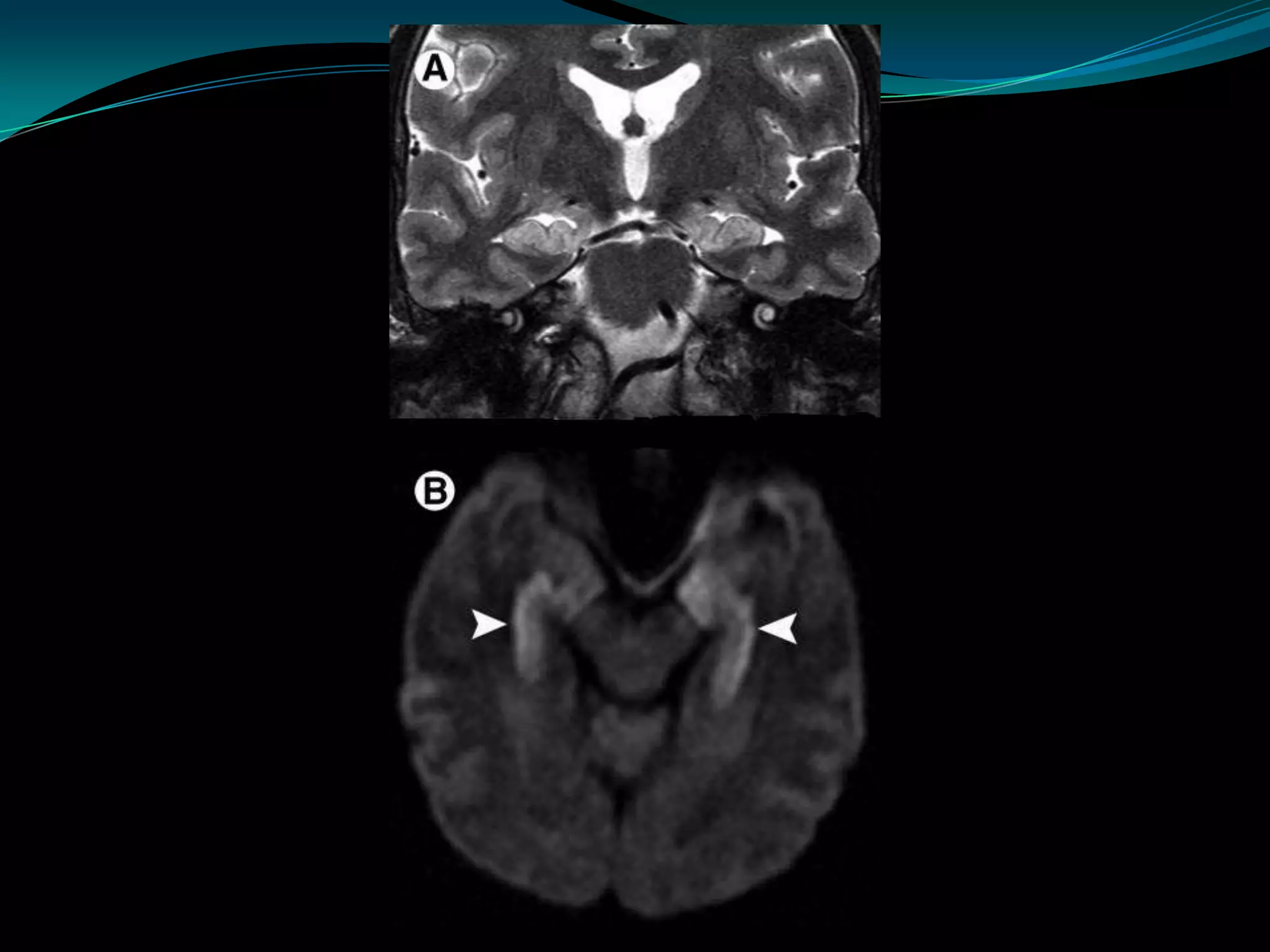 Neuro imaging in epilepsy | PPTX