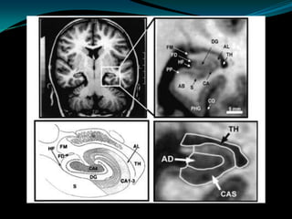 Neuro imaging in epilepsy | PPTX