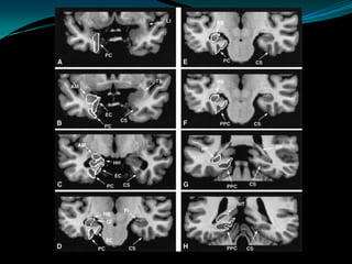 Neuro imaging in epilepsy | PPTX