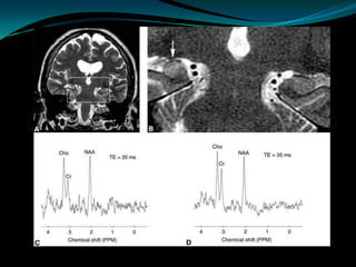 Neuro imaging in epilepsy | PPTX