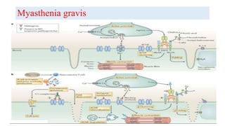Myasthenia gravis
 