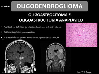 OLIGOASTROCITOMA E
OLIGOASTROCITOMA ANAPLÁSICO
• Regiões bem definidas de oligodendrogliomas e de astrocitoma
• Critério diagnóstico: controvertido
• Natureza bifásica, porém monoclonais, apresentando deleção
1p/19q ou mutação em p53
GLIOMAS
OLIGODENDROGLIOMA
Igor Thé Braga
 