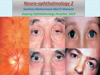 Neuro-ophthalmology 2
Samhaa Mohammed Abd El Moneim
Zagazig Ophthalmology Hospital, 2019
Samhaa Mohammed
 