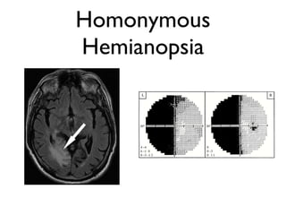 Homonymous Project Introduction to Neuro-ophthalmology | PPT