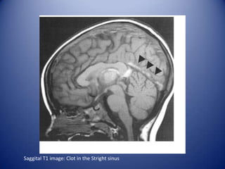 Saggital T1 image: Clot in the Stright sinus

 