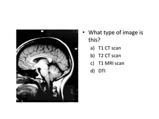 • What type of image is
this?
a) T1 CT scan
b) T2 CT scan
c) T1 MRI scan
d) DTI
 