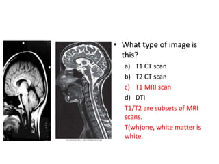 • What type of image is
this?
a) T1 CT scan
b) T2 CT scan
c) T1 MRI scan
d) DTI
T1/T2 are subsets of MRI
scans.
T(wh)one, white matter is
white.
 