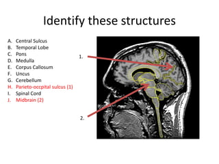 Identify these structures
A. Central Sulcus
B. Temporal Lobe
C. Pons
D. Medulla
E. Corpus Callosum
F. Uncus
G. Cerebellum
H. Parieto-occpital sulcus (1)
I. Spinal Cord
J. Midbrain (2)
1.
2.
 