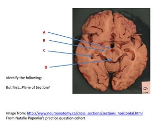 Identify the following:
But first…Plane of Section?
A
B
C
D
Image from: http://www.neuroanatomy.ca/cross_sections/sections_horizontal.html
From Natalie Popenko’s practice question cohort
 