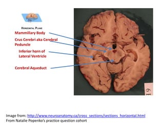 Mammillary Body
Crus Cerebri aka Cerebral
Peduncle
Inferior horn of
Lateral Ventricle
Cerebral Aqueduct
Image from: http://www.neuroanatomy.ca/cross_sections/sections_horizontal.html
From Natalie Popenko’s practice question cohort
 