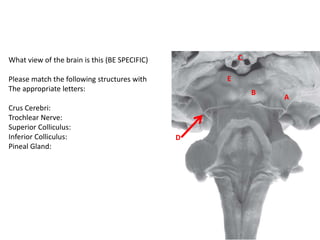 What view of the brain is this (BE SPECIFIC)
Please match the following structures with
The appropriate letters:
Crus Cerebri:
Trochlear Nerve:
Superior Colliculus:
Inferior Colliculus:
Pineal Gland:
C
B
E
A
D
 