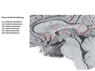 C
F
D
B
G
A
H
EI
J
Please identify the following:
111. Anterior Commissure
112. Posterior Commissure
113. Septum Pellucidum
114. Lamina Terminalis
115. Massa Intermedia
116. (Dorsal) Thalamus
 