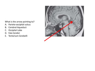 What is the arrow pointing to?
A. Parieto-occipital sulcus
B. Cerebral Aqueduct
C. Occipital Lobe
D. Falx Cerebri
E. Tentorium Cerebelli
 