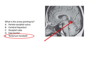What is the arrow pointing to?
A. Parieto-occipital sulcus
B. Cerebral Aqueduct
C. Occipital Lobe
D. Falx Cerebri
E. Tentorium Cerebelli
 