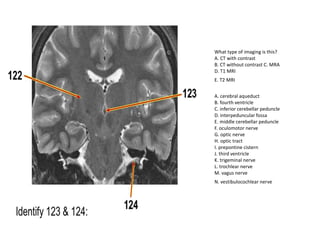 A. cerebral aqueduct
B. fourth ventricle
C. inferior cerebellar peduncle
D. interpeduncular fossa
E. middle cerebellar peduncle
F. oculomotor nerve
G. optic nerve
H. optic tract
I. prepontine cistern
J. third ventricle
K. trigeminal nerve
L. trochlear nerve
M. vagus nerve
N. vestibulocochlear nerve
What type of imaging is this?
A. CT with contrast
B. CT without contrast C. MRA
D. T1 MRI
E. T2 MRI
 
