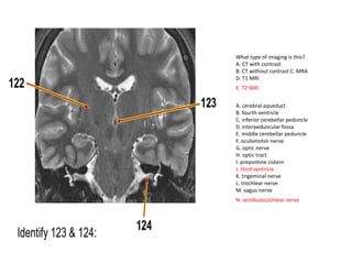 A. cerebral aqueduct
B. fourth ventricle
C. inferior cerebellar peduncle
D. interpeduncular fossa
E. middle cerebellar peduncle
F. oculomotor nerve
G. optic nerve
H. optic tract
I. prepontine cistern
J. third ventricle
K. trigeminal nerve
L. trochlear nerve
M. vagus nerve
N. vestibulocochlear nerve
What type of imaging is this?
A. CT with contrast
B. CT without contrast C. MRA
D. T1 MRI
E. T2 MRI
 