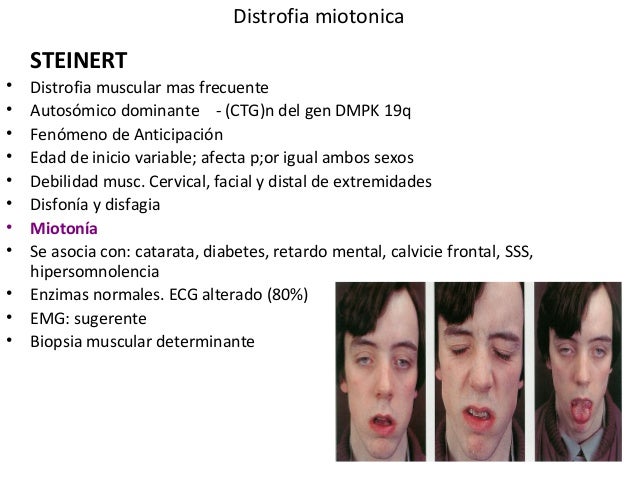 Síndrome de Steinert no âmbito da Medicina Dentária