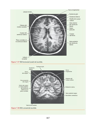 Figura 7-27 RM horizontal (axial) del encéfalo.
Figura 7-28 RM coronal del encéfalo.
467
ERRNVPHGLFRVRUJ
ERRNVPHGLFRVRUJ
 