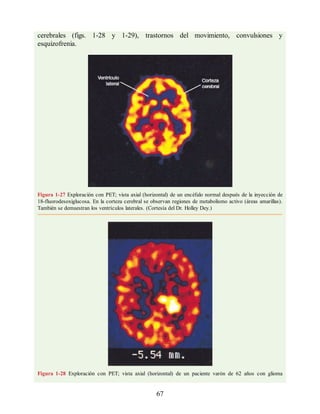 cerebrales (figs. 1-28 y 1-29), trastornos del movimiento, convulsiones y
esquizofrenia.
Figura 1-27 Exploración con PET; vista axial (horizontal) de un encéfalo normal después de la inyección de
18-fluorodesoxiglucosa. En la corteza cerebral se observan regiones de metabolismo activo (áreas amarillas).
También se demuestran los ventrículos laterales. (Cortesía del Dr. Holley Dey.)
Figura 1-28 Exploración con PET; vista axial (horizontal) de un paciente varón de 62 años con glioma
67
ERRNVPHGLFRVRUJ
ERRNVPHGLFRVRUJ
 