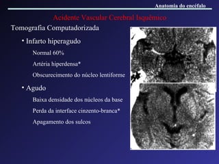 Acidente Vascular Cerebral Isquêmico Tomografia Computadorizada Infarto hiperagudo Normal 60% Artéria hiperdensa* Obscurecimento do núcleo lentiforme Agudo Baixa densidade dos núcleos da base Perda da interface cinzento-branca* Apagamento dos sulcos Anatomia do encéfalo 