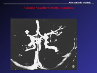 Acidente Vascular Cerebral Isquêmico Anatomia do encéfalo 