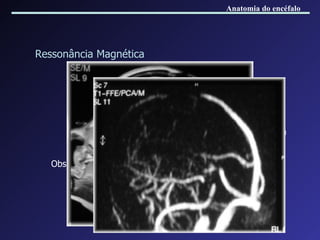 Ressonância Magnética Trombo agudo T1 iso    T1 hiper e T2 hipo Trombo subagudo Hiperintenso* Trombo crônico Fibrose com colaterais proeminentes em volta do seio trombosado Obs: estudos bidimensionais em TOF e PC. Anatomia do encéfalo 