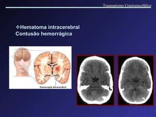 Hematoma intracerebral  Contusão hemorrágica   Traumatismo Cranioencefálico 