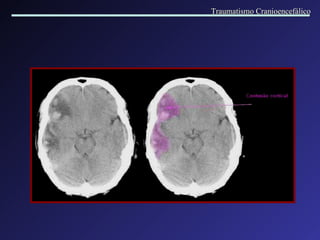 Traumatismo Cranioencefálico 