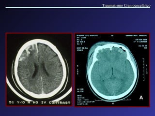 Traumatismo Cranioencefálico 