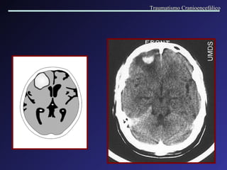 Traumatismo Cranioencefálico 