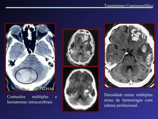 Contusões múltiplas e hematomas intracerebrais Densidade mista: múltiplas áreas de hemorragia com edema perilesional. Traumatismo Cranioencefálico 