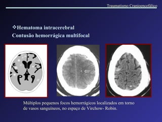 Hematoma intracerebral  Contusão hemorrágica multifocal Múltiplos pequenos focos hemorrágicos localizados em torno de vasos sanguíneos, no espaço de Virchow- Robin. Traumatismo Cranioencefálico 