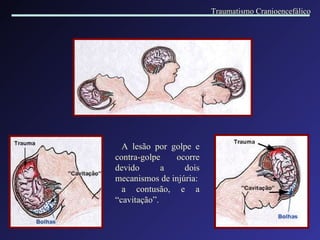 A lesão por golpe e contra-golpe ocorre devido a dois mecanismos de injúria: a contusão, e a “cavitação”. Traumatismo Cranioencefálico 