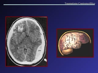 Traumatismo Cranioencefálico 
