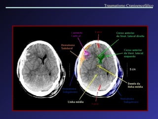 Traumatismo Cranioencefálico 