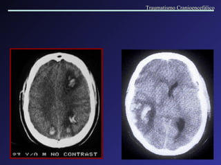 Traumatismo Cranioencefálico 