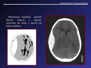 Hematoma Epidural  parietal direito : not a -se o aspecto lenticular da lesão e desvio da linha mediana. Traumatismo Cranioencefálico 