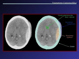 Traumatismo Cranioencefálico 
