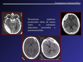Hematomas epidurais produzindo efeito de massa sobre as estruturas adjacentes, associados a pneumoencéfalo. Traumatismo Cranioencefálico 