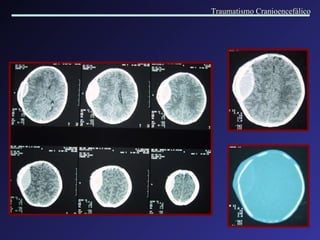 Traumatismo Cranioencefálico 