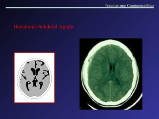 Hematoma Subdural   Agudo Traumatismo Cranioencefálico 
