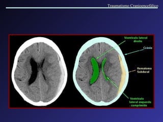 Traumatismo Cranioencefálico 
