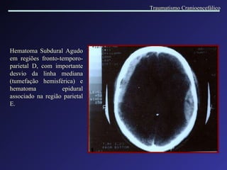 Hematoma Subdural Agudo em regiões fronto-temporo-parietal D, com importante desvio da linha mediana (tumefação hemisférica) e hematoma epidural associado na região parietal E. Traumatismo Cranioencefálico 