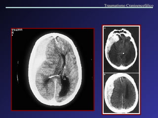 Traumatismo Cranioencefálico 