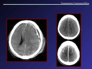 Traumatismo Cranioencefálico 