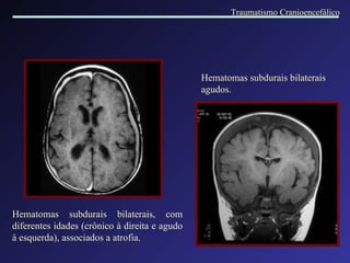 Hematomas subdurais bilaterais, com diferentes idades (crônico à direita e agudo à esquerda), associados a atrofia . Hematomas subdurais bilaterais agudos. Traumatismo Cranioencefálico 