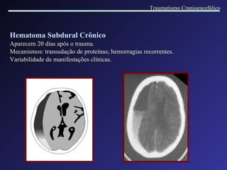 Hematoma Subdural Crônico Aparecem 20 dias após o trauma. Mecanismos: transudação de proteínas; hemorragias recorrentes. Variabilidade de manifestações clínicas. Traumatismo Cranioencefálico 