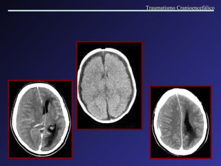 Traumatismo Cranioencefálico 